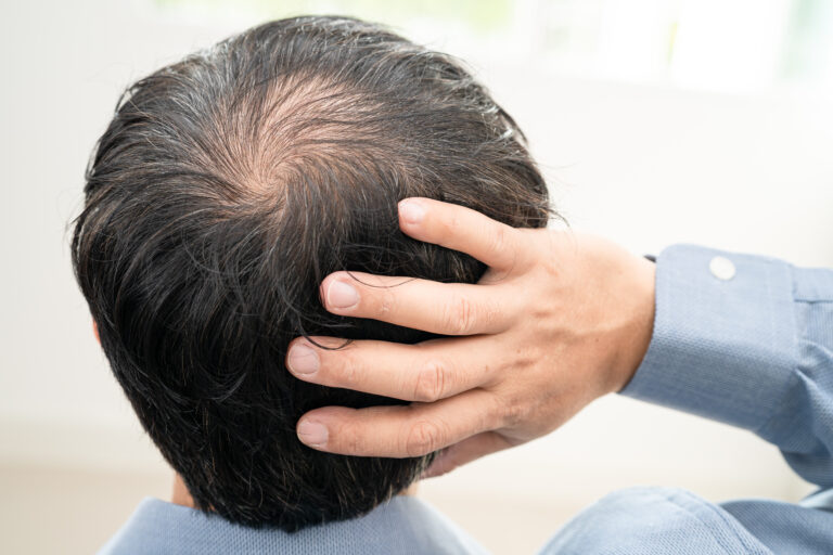 A chi è consigliata una patch capelli?