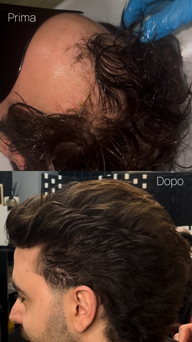 L’applicazione capillare personalizzata è pensata per chi convive con alopecia o calvizie