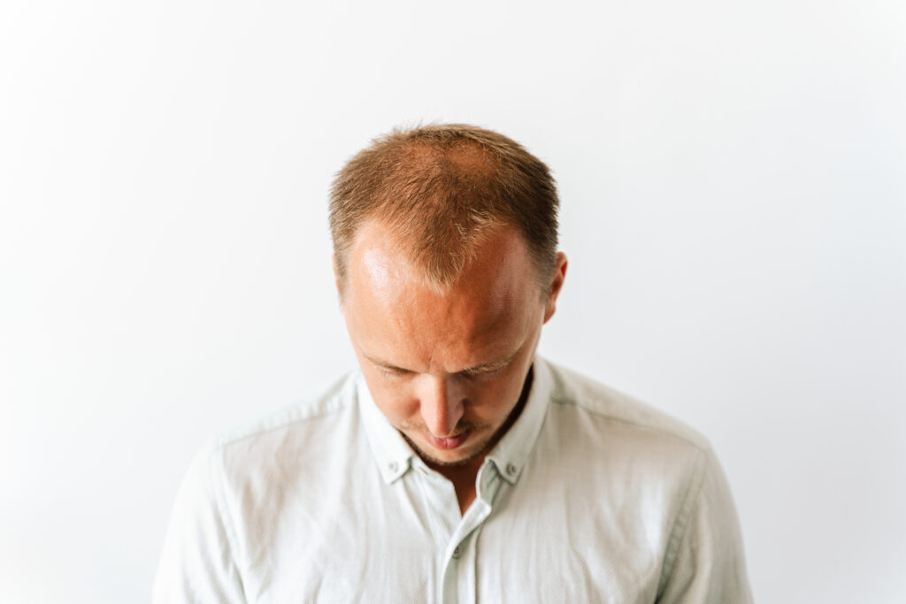 Cos’è una patch capelli uomo?